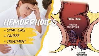 Eliminate Hemorrhoid Pain Causes Symptoms and Expert Treatments by Dr Shiraz Farooq [upl. by Llemor429]