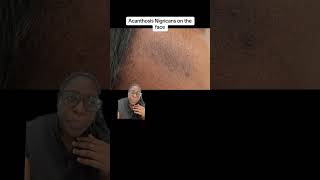 Acanthosis Nigricans on the Face insulinresistance [upl. by Etteuqaj]