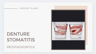 DENTURE STOMATITIS [upl. by Verner]