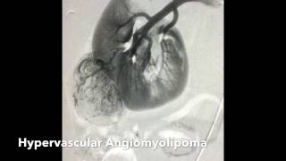 Renal Angiomyolipoma AML Transcatheter Ethanol Alcohol Embolization [upl. by Ybsorc]