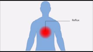 Oesophagite inflammation de l’oesophage [upl. by Atiek]