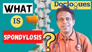 What is Spondylosis [upl. by Rozamond]