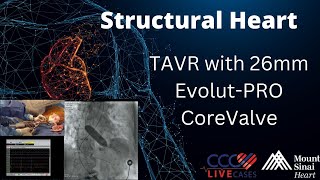 TAVR with 26mm EvolutPRO CoreValve  May 8 2018 [upl. by Standush948]