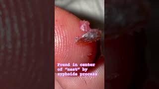 fungus spores mold skin flukes morgellons myjourney skin condition ulcer help share win [upl. by Dhumma]