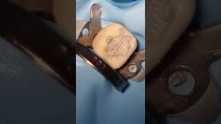 Amalgam Filling Procedure  Step by Step [upl. by Niarda]