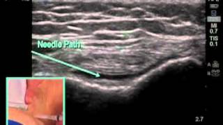 How to Ultrasound Guided Knee Injection Scanning Technique [upl. by Donna351]