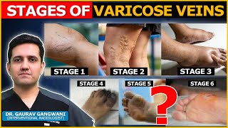 What are the stages of Varicose Veins   Dr Gaurav Gangwani Interventional Radiologist [upl. by Einberger]