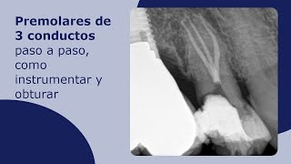 Premolares de 3 conductos paso a paso cómo instrumentar y obturar [upl. by Notsae]