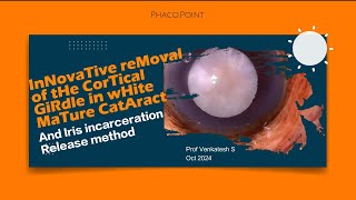 Innovative Removal of the Cortical Girdle in a White Mature Cataract and Iris Incarceration release [upl. by Lraep]