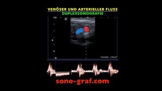 Duplexsonografie  Venöser und arterieller Fluss [upl. by Alel]