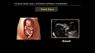 The Basic Fetal Heart Scan [upl. by Akihsar]