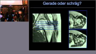 HüftImpingement Radiologische Aspekte einer neu entdeckten Krankheit [upl. by Blim102]