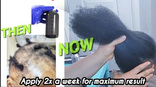 DIY Fast Hair Growth Oil  Grow longer and Thicker hair 10X Faster in 2024 [upl. by Inail]