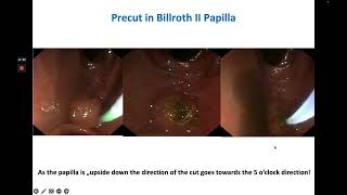 ERCP amp Sphincterotomy in Billroth II Anatomy [upl. by Mcnally]