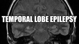 Temporal lobe epilepsy [upl. by Owain187]