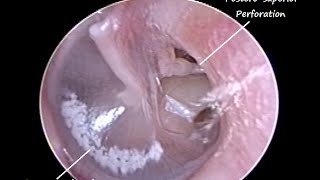 ENT Endoscopy  Chronic Sinusitis with Allergy causing left Eardrum peforation amp Tonsillitis [upl. by Yadnil]