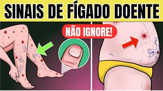 10 SINAIS de PROBLEMA no FÍGADO na PELE  Sintomas de GORDURA NO FÍGADO CIRROSE e HEPATITE [upl. by Noyk]