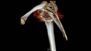 Acromion fracture after RTSA [upl. by Nodle579]