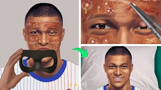 Treatment of ulcers on Kylian Mbappés face caused by wearing a training mask for too long [upl. by Chadbourne]