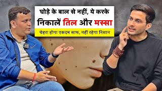 Moles Kaise Hataye Ft ShreeRadhey  Til Ka Ilaj Homeopathic  Masse amp Skin Tags  Himanshu Bhatt [upl. by Booker]