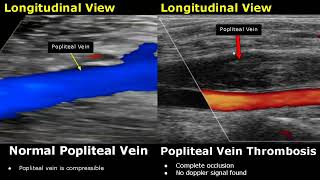 Popliteal Vein Doppler Ultrasound Normal Vs Abnormal Image Appearances  Deep Vein Thrombosis USG [upl. by Frodeen]