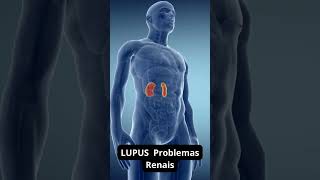 LUPUS Problemas Renais doencaautoimune doencasautoimune lupus [upl. by Nyleuqcaj453]