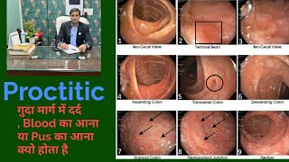 Proctitis Pain in Rectum Chrons Disease  ulcerative Colitis Dr Sanjeet Sahu [upl. by Eirahcaz]