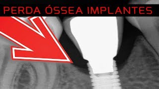 Ep 12 Perda Óssea Precoce em Implantes Dentários [upl. by Nnaeerb]