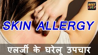 एलर्जी के घरेलू उपचार  HOME REMEDIES FOR SKIN ALLERGY [upl. by Liss770]