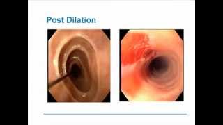 Eosinophilic Esophagitis [upl. by Trude]