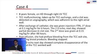 Catheter Related Right Atrial Thrombus CRAT In Dialysis Patients [upl. by Nirrac]