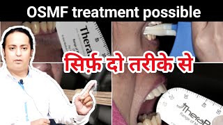 OSMF ऐसे ठीक करें 100 आराम होगा ही OSMF treatment in India। [upl. by Otit]