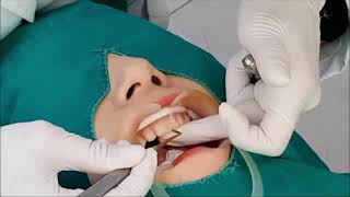 앞니레진 앞니레진 실시간 치료설명 Diastema resin closure real time anterior direct resin treatment [upl. by Drolyag215]