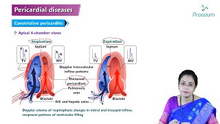 Pericardial Disease Hindi  Etiology Clinical Features Diagnosis Treatment and Complications [upl. by Avot483]