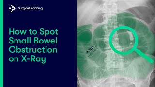 Small Bowel Obstruction  How do we Diagnose it on Abdominal XRay [upl. by Ainorev]