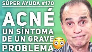 SÚPER AYUDA 170 Acné Un Síntoma De Un Grave Problema [upl. by Anet]