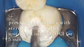 MTA pulpotomy for lower 1st molar with open apices [upl. by Padraig510]