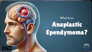 Anaplastic Ependymoma Explained Symptoms Treatment and Hope [upl. by Lanny]