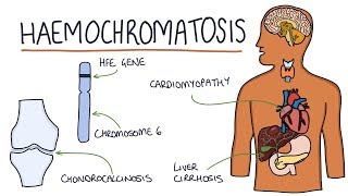 Understanding Haemochromatosis [upl. by Emyaj928]