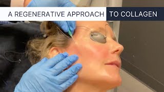 PDO Thread Lift the Ultimate NonSurgical Facelift [upl. by King]