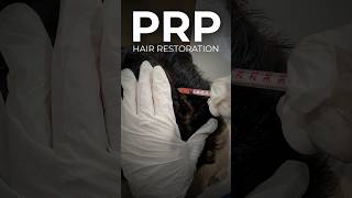 PRP Hair Restoration at CARA [upl. by Delastre]