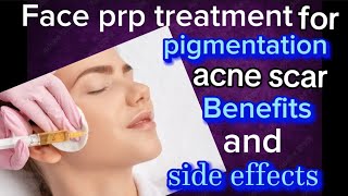 face prp treatment for pigmentation skin rejuvenation acne scarbenefits and sideeffectsprp [upl. by Adyela]