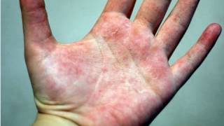 DermTV  How to Treat Eczema DermTVcom Epi 178 [upl. by Elleiad711]