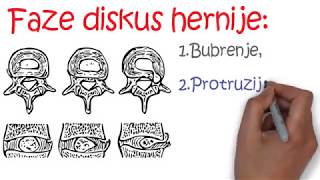 DISKUS HERNIJA [upl. by Diandre]