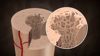 What causes Osteoporosis [upl. by Anjanette]