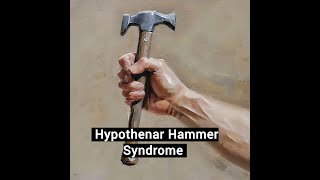 Hypothenar Hammer Syndrome [upl. by Lutim280]