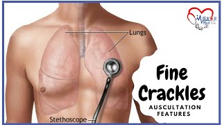 Fine Crackles  Lung Sounds  Auscultation Features [upl. by Ahsimot]