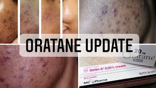 Oratane Update  Oratane Treatment Journey  South African YouTuber [upl. by Ased387]