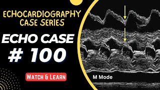 ECHO CASE 100  Echocardiography for Beginners  M Mode Echocardiogram [upl. by Arlin]