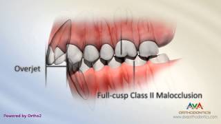 Malocclusion  Class II Div I [upl. by Cagle]